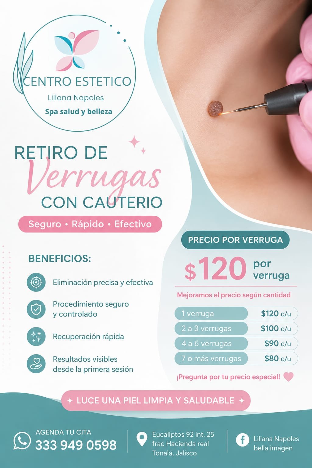 Retiro de verrugas con cauterio - Seguro, rápido y efectivo