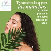 Tratamiento láser avanzado para melasma, manchas por el sol y cicatrices de acné