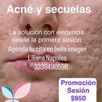 Tratamiento facial especializado para la eliminación de acné y secuelas dérmicas profundas